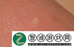 “小白點”奇談