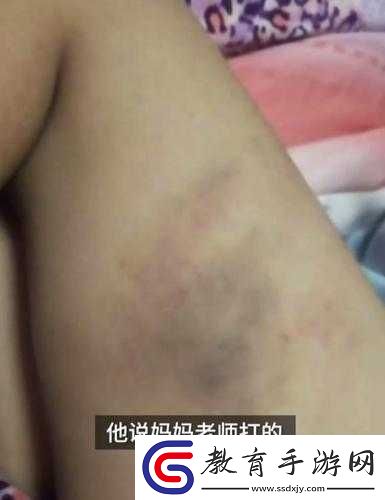 竹板打腫臂縫合不上