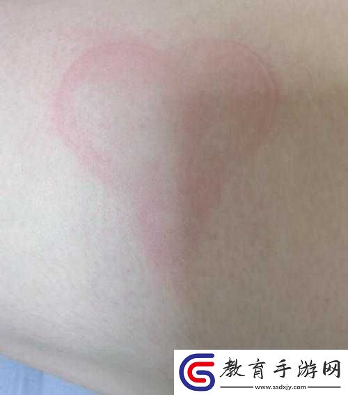 SP發刷紅腫雙丘